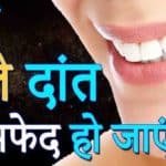 दांतों का पीलापन