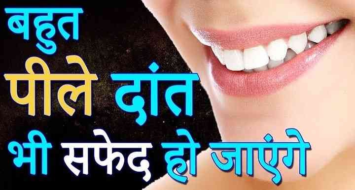 दांतों का पीलापन