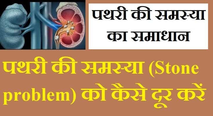 Men Stone Problem पथरी की समस्या (Stone problem) को कैसे दूर करें? जानें उपाय