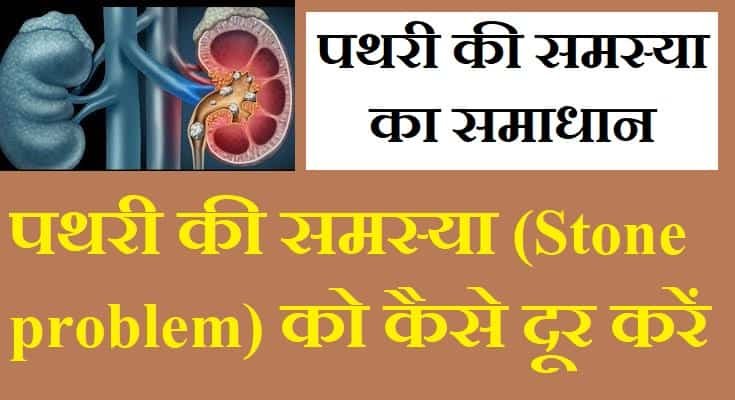 पथरी की समस्या (Stone problem) को कैसे दूर करें