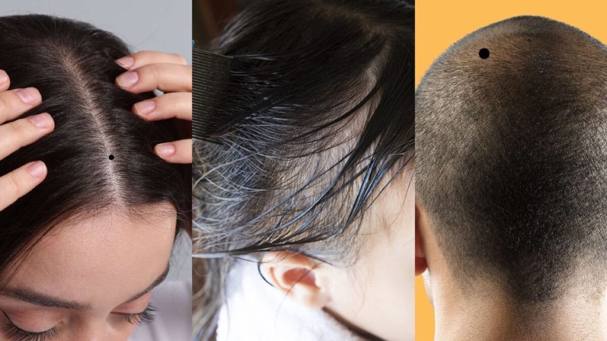 बच्चे के सिर पर तिल होना