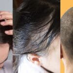 बच्चे के सिर पर तिल होना