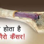 Bone Cancer के लक्षण